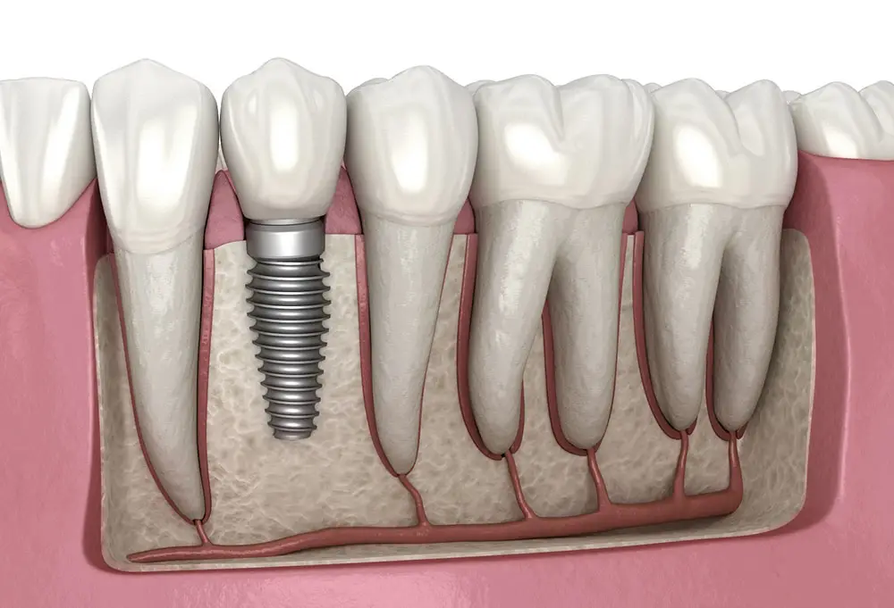 Dental Implants: A Complete Guide