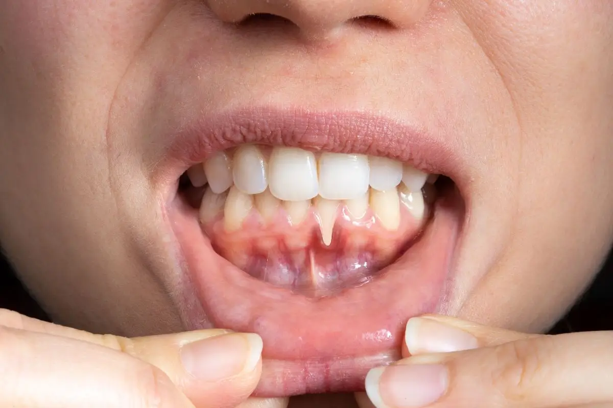 Gum Disease: Causes and Treatment