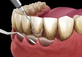 Periodontal Treatment